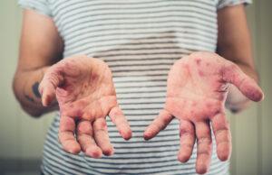 Additional measles cases identified measles